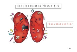 C O N S E Q U Ê N C I A D A P R E S S Ã O A L TA
“ D a n o s é r i o n o s r i n s . “
M I N I S T É R I O D A S A Ú D E
C o o r d e n a ç ã o d e D o e n ç a s C r ô n ic o - D e g e n e r a t iv a s 40
 