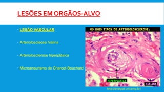 LESÕES EM ORGÃOS-ALVO
 LESÃO VASCULAR
 Arterioloscleose hialina
 Arteriolosclerose hiperplásica
 Microaneurisma de Charcot-Bouchard
http://anatpat.unicamp.br/
 