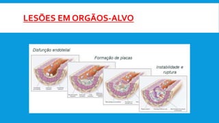 LESÕES EM ORGÃOS-ALVO
 