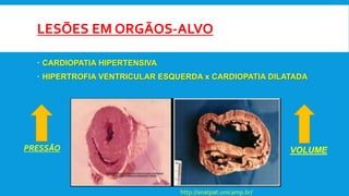 LESÕES EM ORGÃOS-ALVO
 CARDIOPATIA HIPERTENSIVA
 HIPERTROFIA VENTRICULAR ESQUERDA x CARDIOPATIA DILATADA
PRESSÃO VOLUME
http://anatpat.unicamp.br/
 
