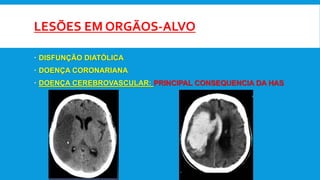 LESÕES EM ORGÃOS-ALVO
 DISFUNÇÃO DIATÓLICA
 DOENÇA CORONARIANA
 DOENÇA CEREBROVASCULAR: PRINCIPAL CONSEQUENCIA DA HAS
 