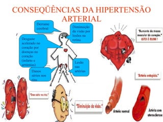 CONSEQÜÊNCIAS DA HIPERTENSÃO ARTERIAL Diminuição da visão por lesões na retina Derrame cerebral Desgaste acelerado no coração por doenças no coração (infarto e arritmias) Danos sérios nos rins Lesão nas artérias 