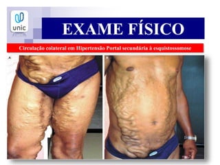 EXAME FÍSICO
Circulação colateral em Hipertensão Portal secundária à esquistossomose
 
