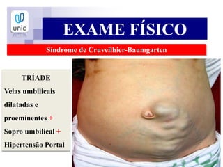 EXAME FÍSICO
Síndrome de Cruveilhier-Baumgarten
TRÍADE
Veias umbilicais
dilatadas e
proeminentes +
Sopro umbilical +
Hipertensão Portal
 