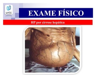 EXAME FÍSICO
HP por cirrose hepática
 