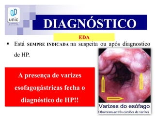  Está SEMPRE INDICADA na suspeita ou após diagnostico
de HP.
DIAGNÓSTICO
A presença de varizes
esofagogástricas fecha o
diagnóstico de HP!!
EDA
 