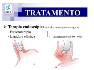 TRATAMENTO
 Terapia endoscópica (escolha no sangramento agudo)
- Escleroterapia
- Ligadura elástica sangramento em 80 – 90%
 