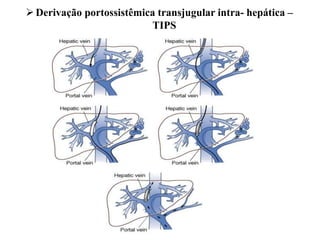 Derivação portossistêmica transjugular intra- hepática –
TIPS
 