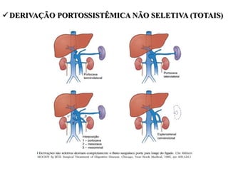  DERIVAÇÃO PORTOSSISTÊMICA NÃO SELETIVA (TOTAIS)
 