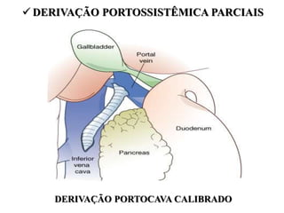  DERIVAÇÃO PORTOSSISTÊMICA PARCIAIS
DERIVAÇÃO PORTOCAVA CALIBRADO
 