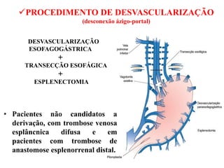 PROCEDIMENTO DE DESVASCULARIZAÇÃO
(desconexão ázigo-portal)
DESVASCULARIZAÇÃO
ESOFAGOGÁSTRICA
+
TRANSECÇÃO ESOFÁGICA
+
ESPLENECTOMIA
• Pacientes não candidatos a
derivação, com trombose venosa
esplâncnica difusa e em
pacientes com trombose de
anastomose esplenorrenal distal.
 