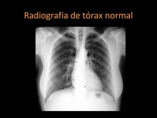 Radiografia de tórax normal
 