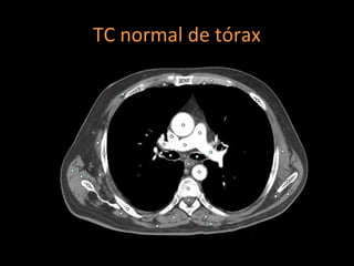 TC normal de tórax
 