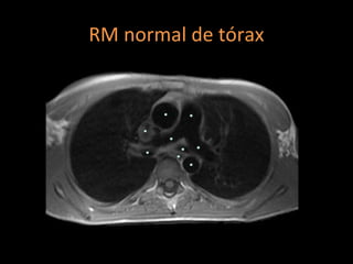 RM normal de tórax
 