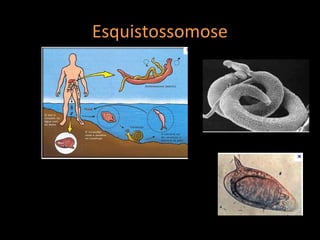 Esquistossomose
 