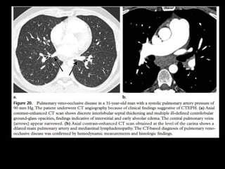 http://radiographics.rsna.org/content/30/7/1753.full.pdf+html
 