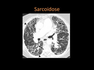 Sarcoidose




http://radiographics.rsna.org/content/30/7/1753.full.pdf+html
 