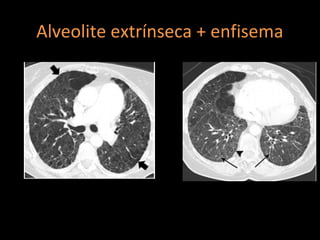 Alveolite extrínseca + enfisema




        http://radiographics.rsna.org/content/30/7/1753.full.pdf+html
 