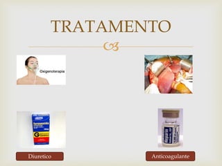 
TRATAMENTO
Diuretico Anticoagulante
 