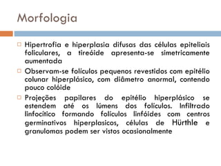 Morfologia Hipertrofia e hiperplasia difusas das células epiteliais foliculares, a tireóide apresenta-se simetricamente aumentada Observam-se folículos pequenos revestidos com epitélio colunar hiperplásico, com diâmetro anormal, contendo pouco colóide Projeções papilares do epitélio hiperplásico se estendem até os lúmens dos folículos. Infiltrado linfocítico formando folículos linfóides com centros germinativos hiperplasicos, células de  Hürthle  e granulomas podem ser vistos ocasionalmente 
