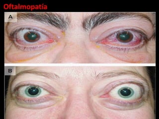 Oftalmopatía
 