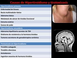 Causas de Hipertiroidismo y tirotoxicosis
Hipertiroidismo primario
Enfermedad de Graves
Bocio multinodular tóxico
Adenoma tóxico
Metástasis de cáncer de tiroides funcional
Estruma ovárico
Exceso de yodo
Hipertiroidismo secundario
Adenoma hipofisiario secretor de TSH
Síndrome de resistencia a la hormona tiroidea
Tumores secretores de gonadotropina coriónica


Tirotoxicosis sin hipertiroidismo
Tiroiditis subaguda
Tiroiditis silenciosa
Amiodarona
Ingestion excesiva de hormona tiroidea
 