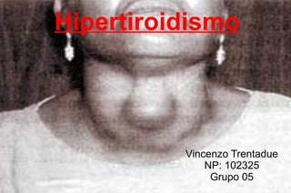Hipertiroidismo
Vincenzo Trentadue
NP: 102325
Grupo 05
 