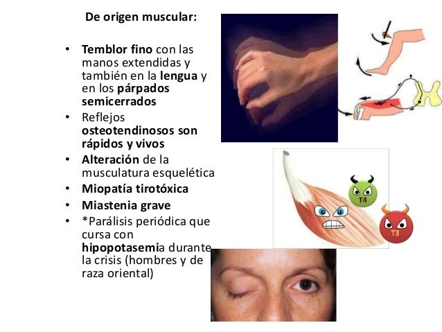 Hipertiroidismo
