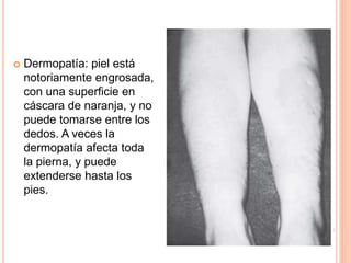  Dermopatía: piel está 
notoriamente engrosada, 
con una superficie en 
cáscara de naranja, y no 
puede tomarse entre los 
dedos. A veces la 
dermopatía afecta toda 
la pierna, y puede 
extenderse hasta los 
pies. 
 