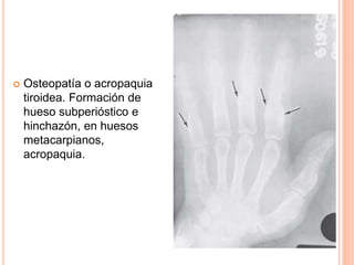  Osteopatía o acropaquia 
tiroidea. Formación de 
hueso subperióstico e 
hinchazón, en huesos 
metacarpianos, 
acropaquia. 
 