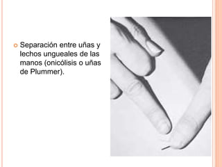 Separación entre uñas y 
lechos ungueales de las 
manos (onicólisis o uñas 
de Plummer). 
 
