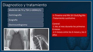 Diagnostico y tratamiento
Medición de T4 y TSH (>100MU/L)
Gammagrafía
Ecografía
Electrocardiograma
-L-Tiroxina oral RN 10-15uG/kg/día
-Tratamiento sustitutivo
Control:
-1 Vez al mes durante los primeros
6 meses
-2-3 meses entre los 6 meses y los 2
años
 