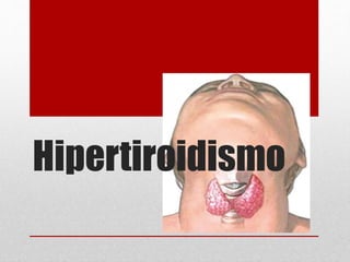 Hipertiroidismo
 