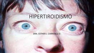 HIPERTIROIDISMO
DRA. ESTHER J. CARRASCO D.
 