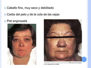  Cabello fino, muy seco y debilitado
 Caída del pelo y de la cola de las cejas
 Piel engrosada
 