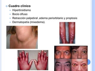  Cuadro clínico
 Hipertiroidismo
 Bocio difuso
 Retracción palpebral ,edema periorbitario y proptosis
 Dermatopatía (mixedema).
 
