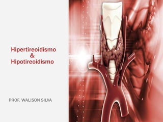 Hipertireoidismo
&
Hipotireoidismo
PROF. WALISON SILVA
 