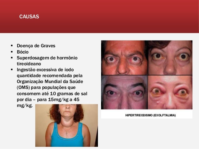 Hipertireoidismo Sintomas Hipertireoidismo Tireoide Dicas De Saude