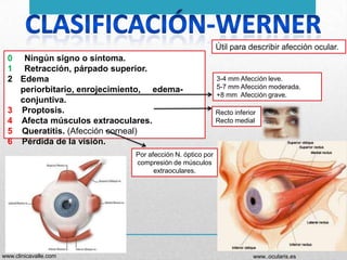 Útil para describir afección ocular.

0 Ningún signo o síntoma.
1 Retracción, párpado superior.
2 Edema
periorbitario, enrojecimiento, edemaconjuntiva.
3 Proptosis.
4 Afecta músculos extraoculares.
5 Queratitis. (Afección corneal)
6 Pérdida de la visión.

3-4 mm Afección leve.
5-7 mm Afección moderada.
+8 mm Afección grave.
Recto inferior
Recto medial

Por afección N. óptico por
compresión de músculos
extraoculares.

www.clinicavalle.com

www..ocularis.es

 