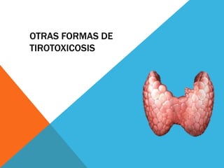 OTRAS FORMAS DE
TIROTOXICOSIS

 