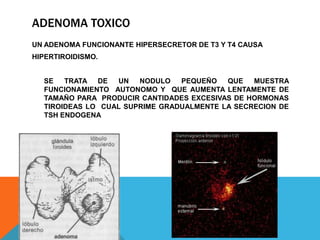 ADENOMA TOXICO
UN ADENOMA FUNCIONANTE HIPERSECRETOR DE T3 Y T4 CAUSA
HIPERTIROIDISMO.
SE
TRATA DE
UN
NODULO
PEQUEÑO
QUE
MUESTRA
FUNCIONAMIENTO AUTONOMO Y QUE AUMENTA LENTAMENTE DE
TAMAÑO PARA PRODUCIR CANTIDADES EXCESIVAS DE HORMONAS
TIROIDEAS LO CUAL SUPRIME GRADUALMENTE LA SECRECION DE
TSH ENDOGENA

 