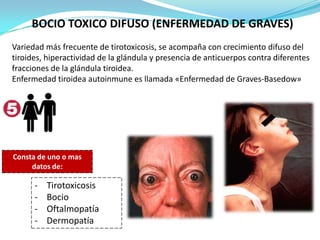 BOCIO TOXICO DIFUSO (ENFERMEDAD DE GRAVES)
Variedad más frecuente de tirotoxicosis, se acompaña con crecimiento difuso del
tiroides, hiperactividad de la glándula y presencia de anticuerpos contra diferentes
fracciones de la glándula tiroidea.
Enfermedad tiroidea autoinmune es llamada «Enfermedad de Graves-Basedow»

Consta de uno o mas
datos de:

-

Tirotoxicosis
Bocio
Oftalmopatía
Dermopatía

 