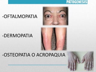 PATOGENESIS

-OFTALMOPATIA

-DERMOPATIA

-OSTEOPATIA O ACROPAQUIA

 