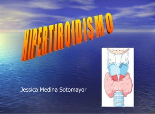HIPERTIROIDISMO Jessica Medina Sotomayor 