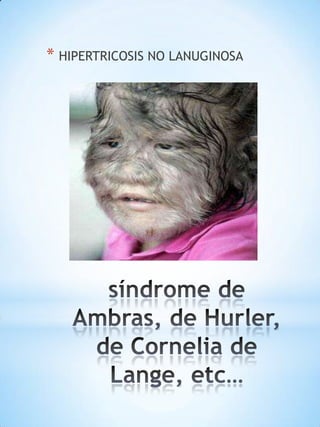 * HIPERTRICOSIS NO LANUGINOSA

 