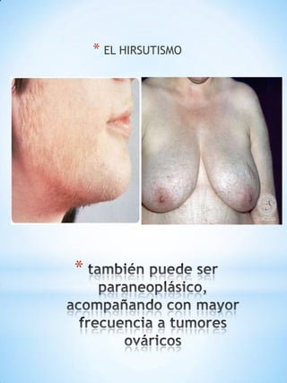 * EL HIRSUTISMO

*

 