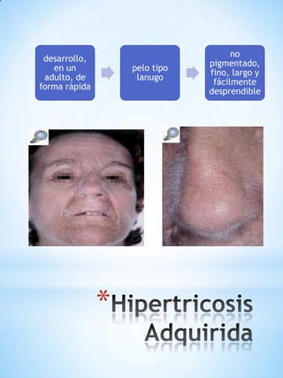 desarrollo,
en un
adulto, de
forma rápida

pelo tipo
lanugo

*

no
pigmentado,
fino, largo y
fácilmente
desprendible

 
