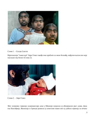 3
Слика 1. – Сестре Сангли
Најпознатији ''човек вук'' Лари Гомез такође има проблем са овом болешћу, међутим његов син није
наследио ову болест (Слика 2).
Слика 2. – Лари Гомез
Због погрешне терапије седамнаесторо деце у Шпанији искусила су абнормални раст длака. Деца
иза Кантабрије, Валенсије и Гранаде развила су симптоме након што су добила терапију за лечење
 