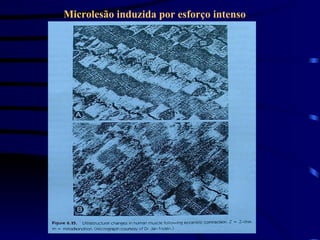 Microlesão induzida por esforço intenso 