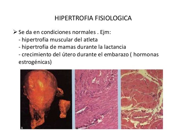 Hipertrofia
